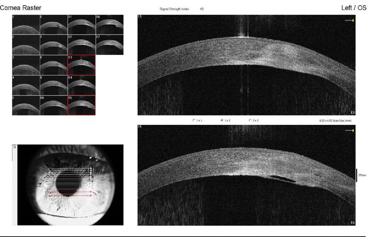 Fig. 2. Imaging of a resolving corneal hydrops in a patient with keratoconus, highlighting corneal edema and the break in Descemet’s membrane.