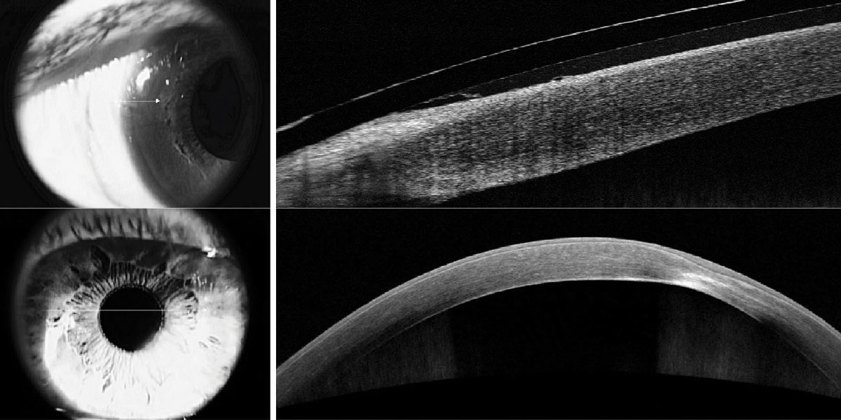 Fig. 3. Limbal microcysts under a scleral contact lens exhibiting limbal vault (left). Corneal scarring and opacification identifying the corneal layers involved (right).