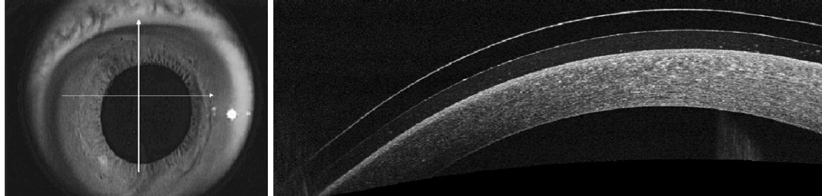 Fig. 5. Murky, debris-filled tear reservoir under a scleral lens.