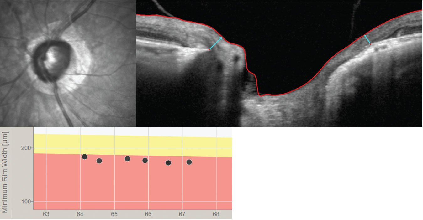 The BMO-MRW (light blue arrows) may be a better way to track progression than the RNFL in high myopes who are suspected of having glaucoma or in those with confirmed myopic glaucoma.