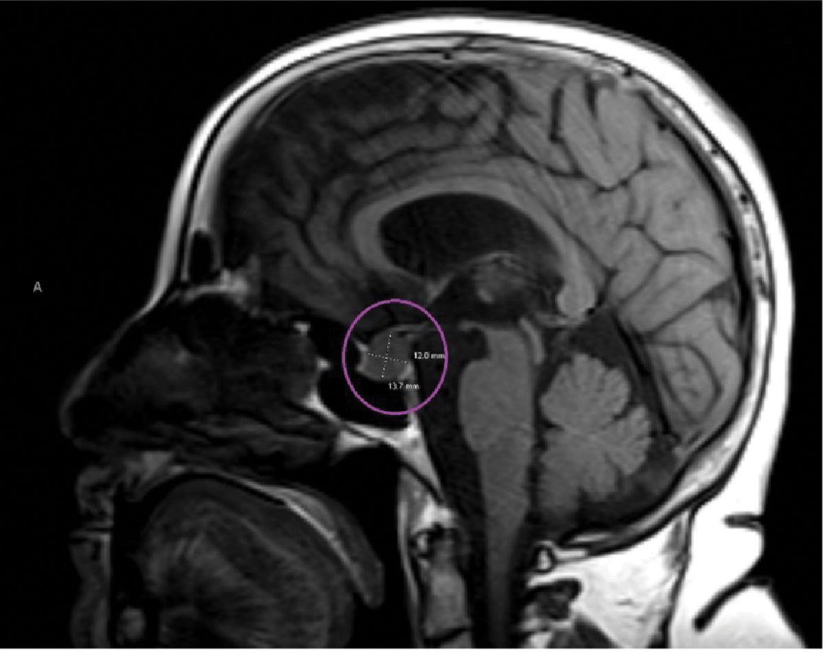 Sagittal MRI reveals a pituitary lesion, most likely a macroadenoma (circled in purple). It was described to be abutting both optic nerves anterior to the chiasm.