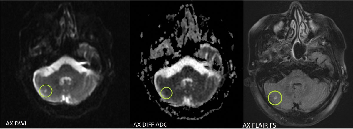 Axial MRI images show acute lacunar infarct (circled in green) of the right cerebellar hemisphere. Areas that are bright on diffusion weighted images and dark on apparent diffusion coefficient are consistent with acute infarct.8 A hyperintense area can be seen on fluid attenuated inversion recovery imaging due to the presence of vasogenic edema within hours after an acute stroke.