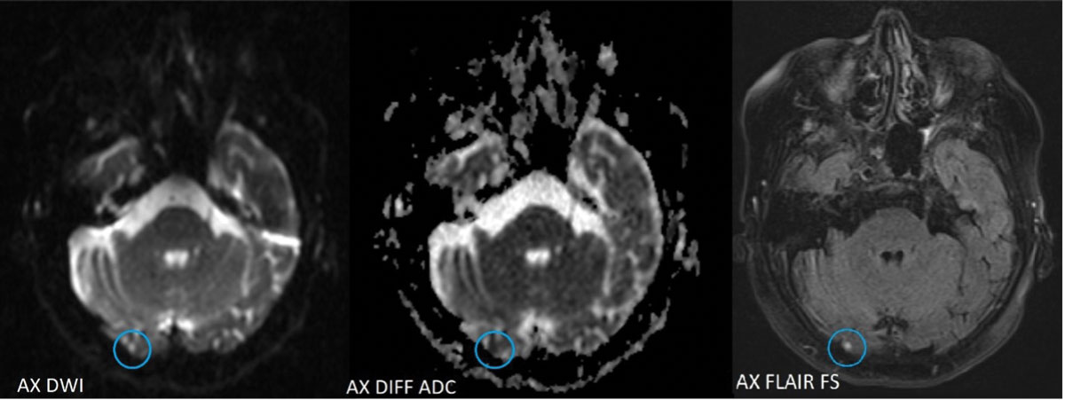 Axial MRI images show acute lacunar infarct (circled in blue) of the inferior medial aspect of the lingual gyrus of the right occipital lobe.