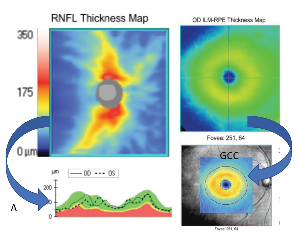 Fig. 1. Basic scanning patterns such as the optic disc cube (left) and macular cube (right) can be used to extrapolate a wealth of information such as RNFL thickness maps (top left) and RNFL TSNIT curves (bottom left), macular thickness maps (top right) and ganglion cell complex thickness maps (bottom right). These types of scans may also provide deviation plots to compare your patient to a normative database. Scans from a Zeiss Cirrus.
