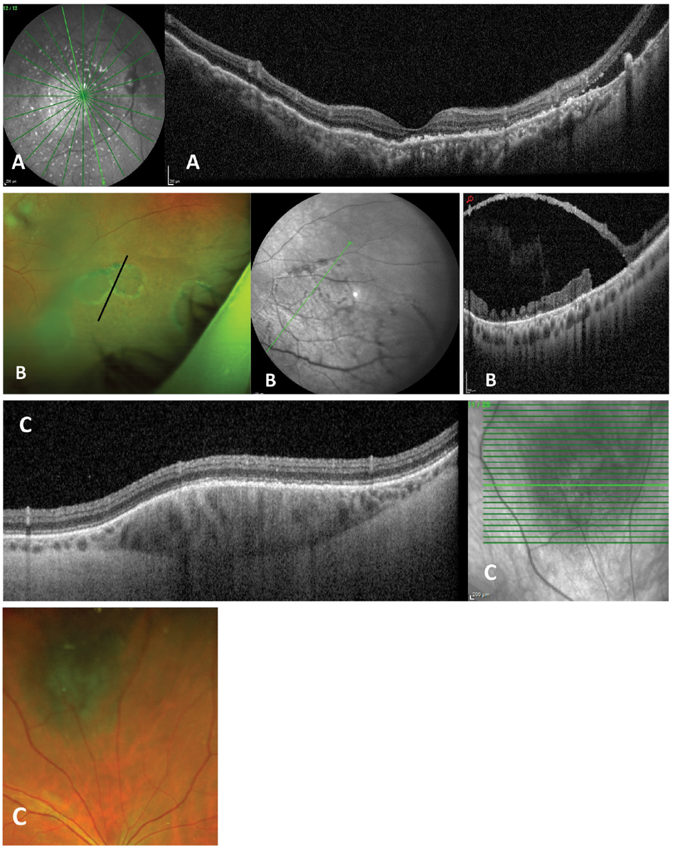 Fig. 2. Complex or customizable scanning patterns along with wider fields of view are available on some instruments. Examples are (A) 55° widefield radial scan through the macula of patient with uveal effusion syndrome. (B) Peripheral OCT of patient with large outer layer retinal breaks within a retinoschisis. (C) A customized cube scan through a midperipherally located choroidal nevus. All images from a Heidelberg Spectralis.