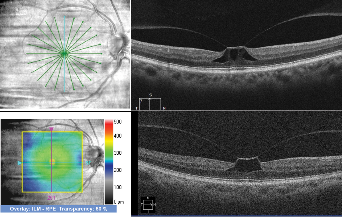 Fig. 3. Comparison of a high-resolution radial scan (top) and lower-resolution cube scan (bottom) performed on a patient with vitreomacular traction. Both are good quality scans, but they are different types, with the radial scan offering higher resolution and more slices through the fovea. Scans taken with Zeiss Cirrus OCT.