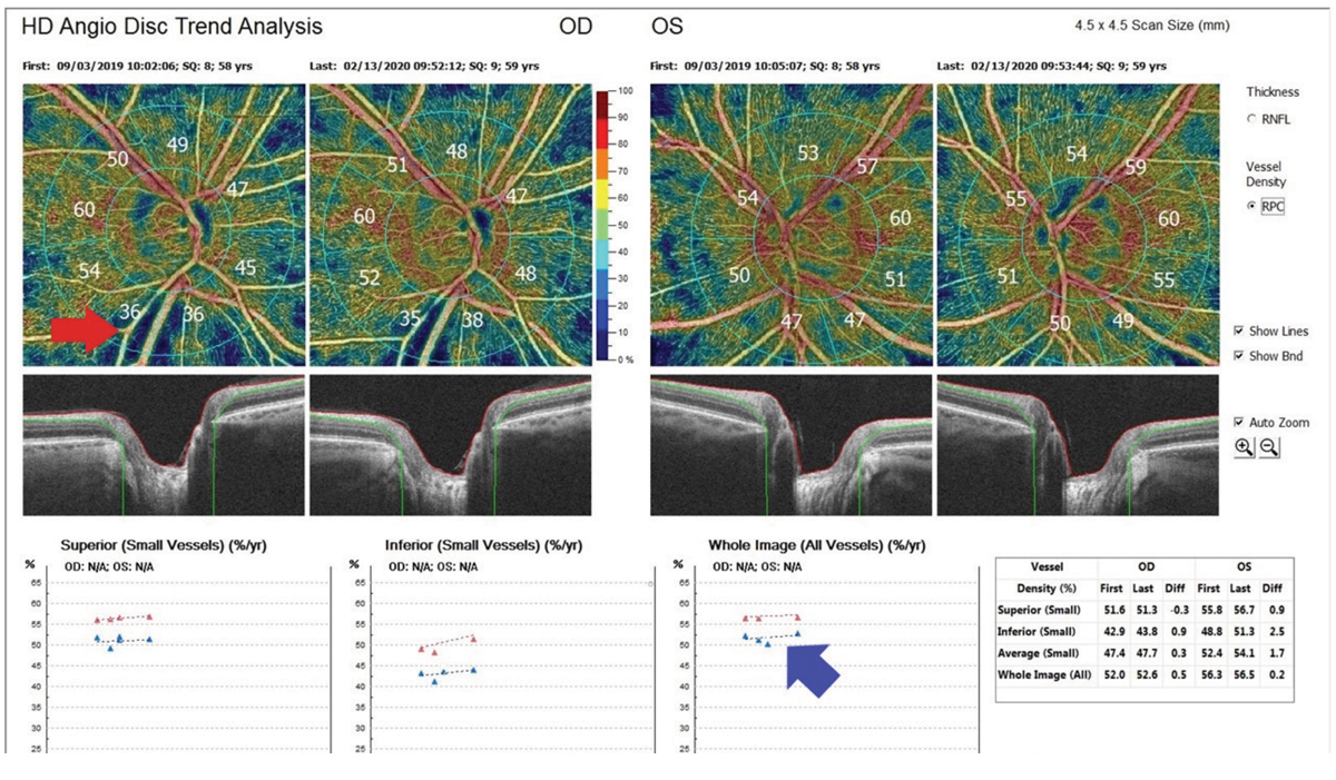 Fig. 4. This is an image of OCT-A glaucoma progression analysis from an Avanti from Visionix (Optovue). The top left red arrow shows a nerve fiber layer defect, and the bottom right blue arrow shows optic nerve perfusion improvement after treatment.