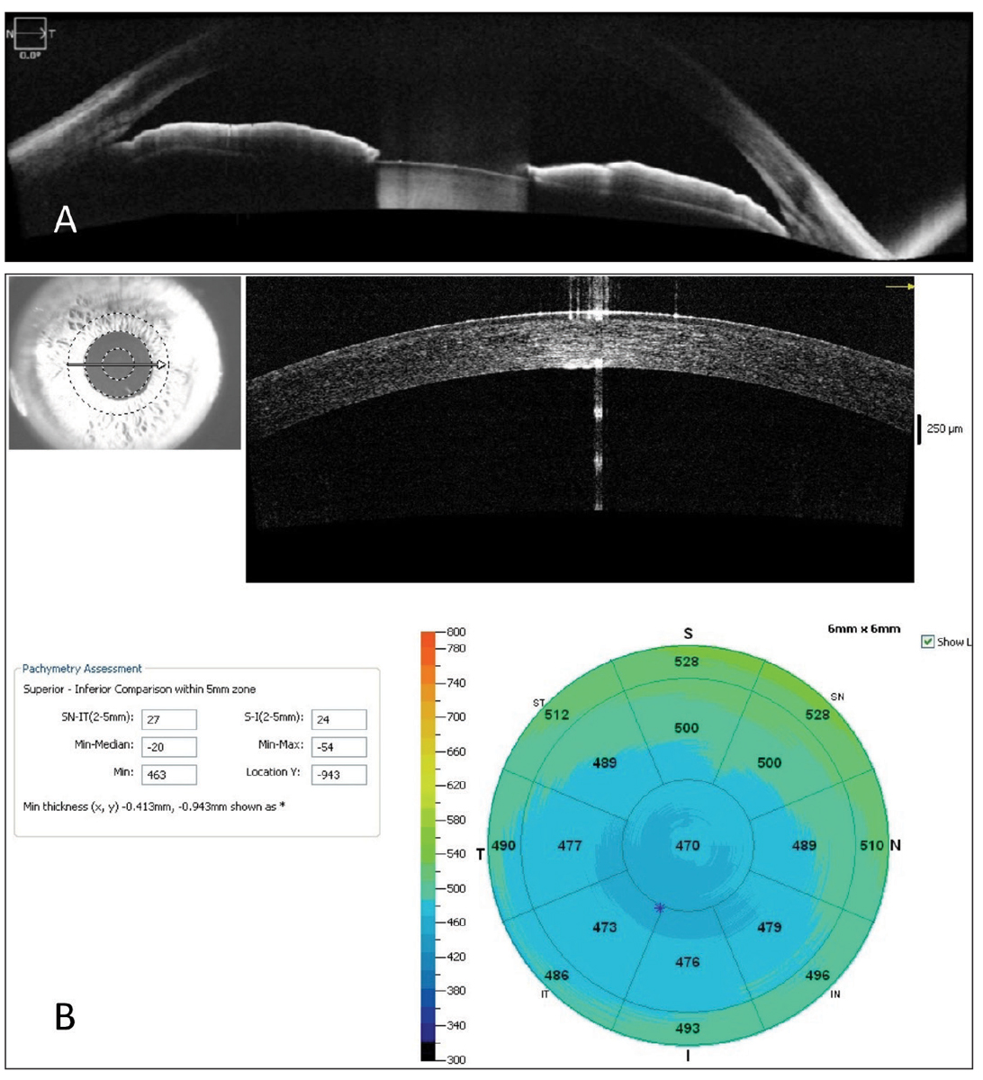 Fig. 5. An anterior segment OCT (A) used to evaluate a patient with anatomically narrow angles taken with Zeiss’s Cirrus OCT, and (B) optical pachymetry measurements performed with the Optovue Avanti OCT from Visionix.
