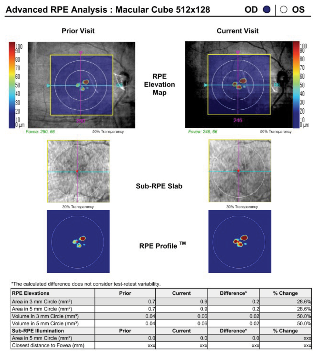 Fig. 6. A macular cube scan on the Cirrus can be used to extrapolate and track drusen volume using its Advanced RPE Analysis software. 