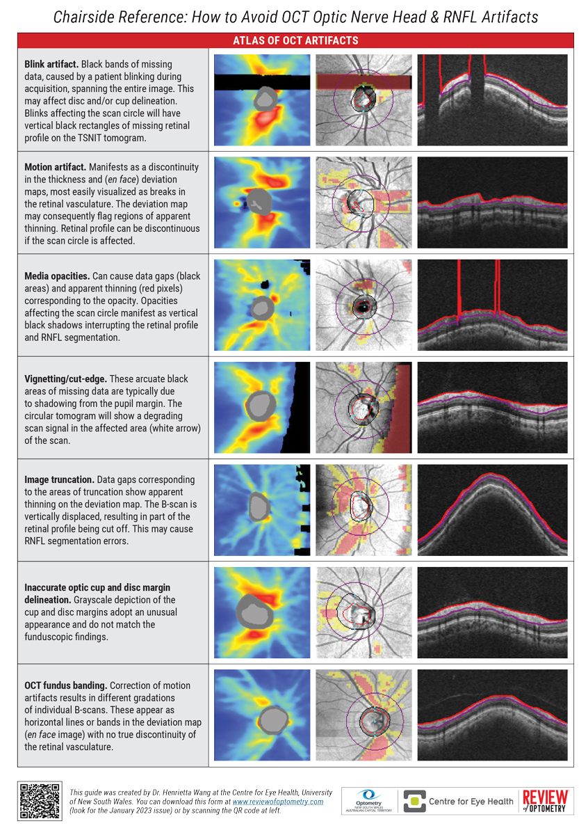 Chairside Reference: How to Avoid OCT Optic Nerve Head & RNFL Artifacts Guide by Henrietta Wang, BOptom (Hons), BSC, MPH