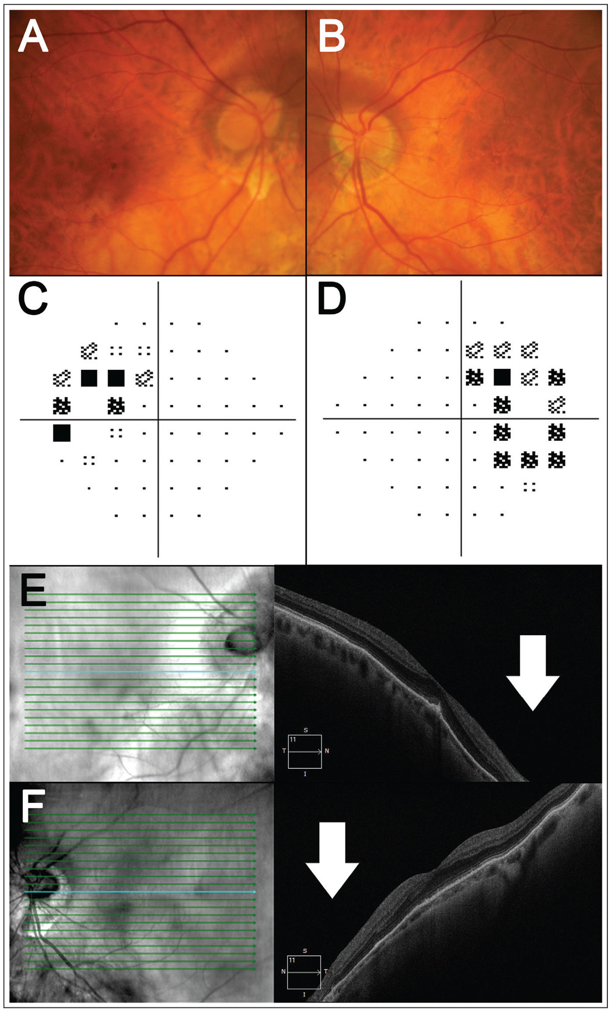Fig. 1. A patient with bilateral tilted disc syndrome. (A-B) Fundus photography shows tilt and/or oblique insertion of the discs in both eyes with situs invertus of the blood vessels. (C-D) Here, 24-2 visual field testing shows a bitemporal visual field defect. (E-F) Horizontal OCT line scans through the fovea show posterior bowing of the nasal retina relative to the fovea (white arrows), corresponding to the temporal visual field defects.