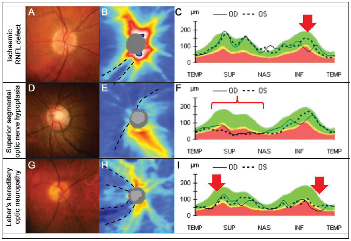 Fig. 3. An example of an ischemic RNFL defect. (A) The right disc has an intact neuroretinal rim with a deep inferior RNFL defect inferiorly. (B) OCT thickness heat map shows deep and focal RNFL thinning that is not contiguous with the disc inferotemporal (black dashed lines). (C) RNFL TSNIT graph shows focal and steep loss of the RNFL inferotemporally in the left eye (red arrow). (D-F) An example of superior segmental optic nerve hypoplasia (SSONH). (D) Classic funduscopic features of SSONH (superior displacement of the central retinal artery with a superior scleral halo. (E) OCT thickness heat map shows diffuse and deep RNFL thinning extending nasally to superiorly in an anti-clockwise manner (black dashed lines). (F) RNFL TSNIT graph shows generalized thinning in the nasal and superior aspects (red bracket). (G-I) An example of Leber’s hereditary optic neuropathy. (G) The right disc shows temporal pallor with an otherwise intact neuroretinal rim. (H) OCT thickness heat map shows deep superotemporal and inferotemporal thinning of the RNFL (black dashed lines). (I) RNFL TSNIT graph shows RNFL thinning, more marked inferotemporally than superotemporally (red arrows).