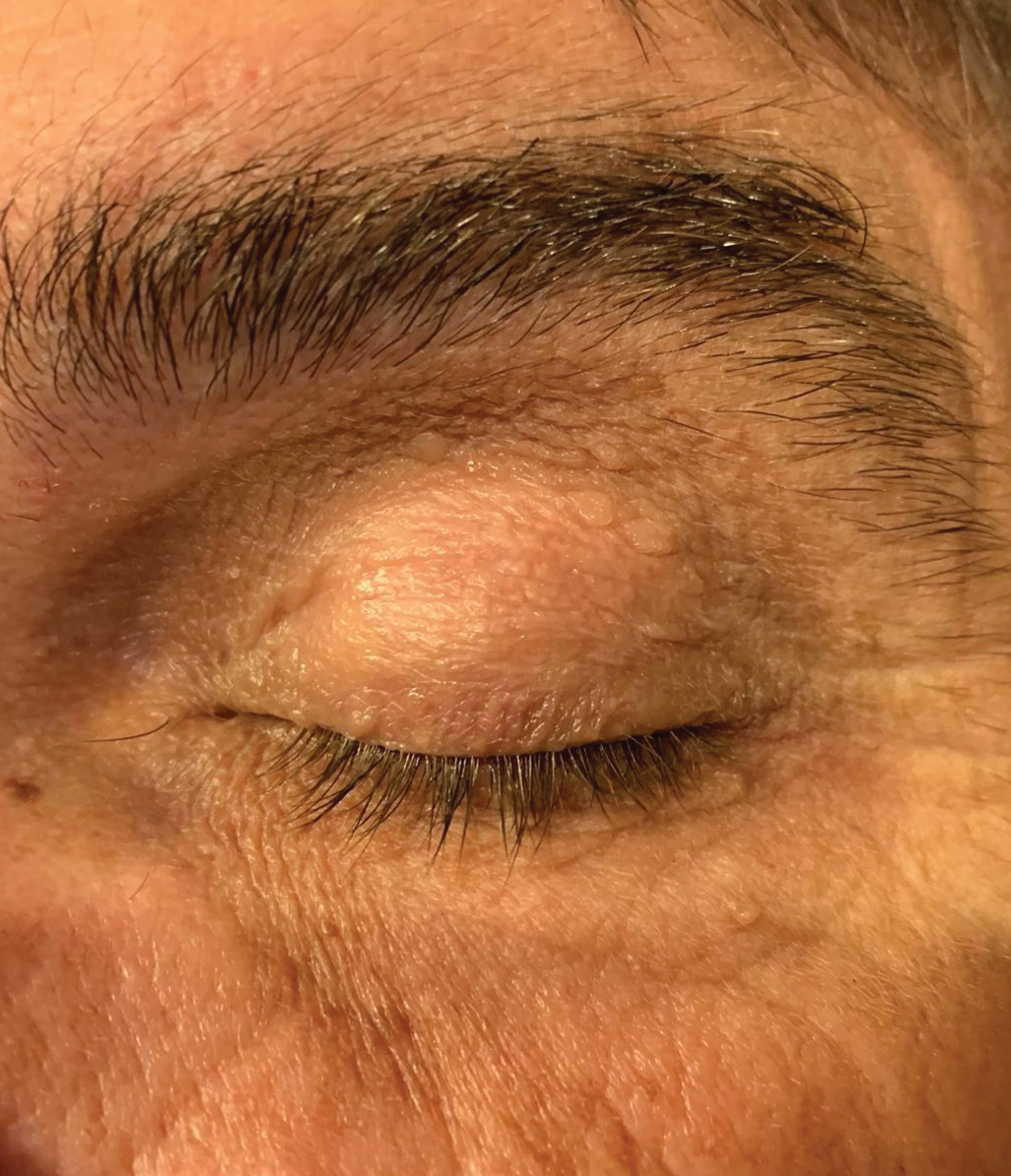 Fig. 3b. One month post-op appearance of the same patient showing complete resolution of the chalazion.