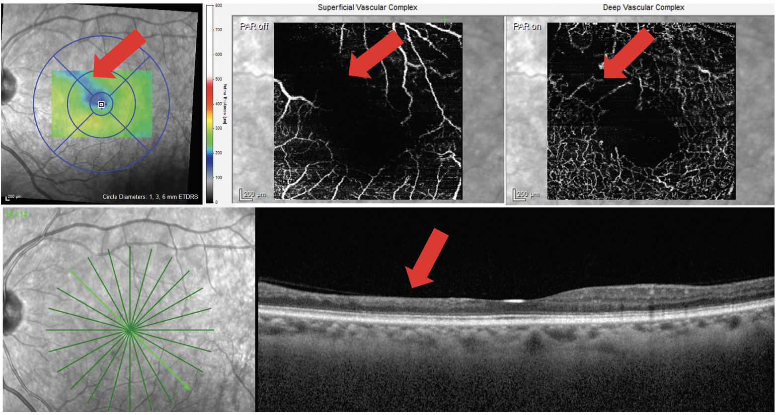 Fig. 9. A patient with DR presents with a localized area of inner retinal thinning on OCT cross-section scan. This corresponds to an area of macular thinning on the thickness map (top left image) as well as capillary non-perfusion in the superficial and deep capillary plexi (top middle and top right images).