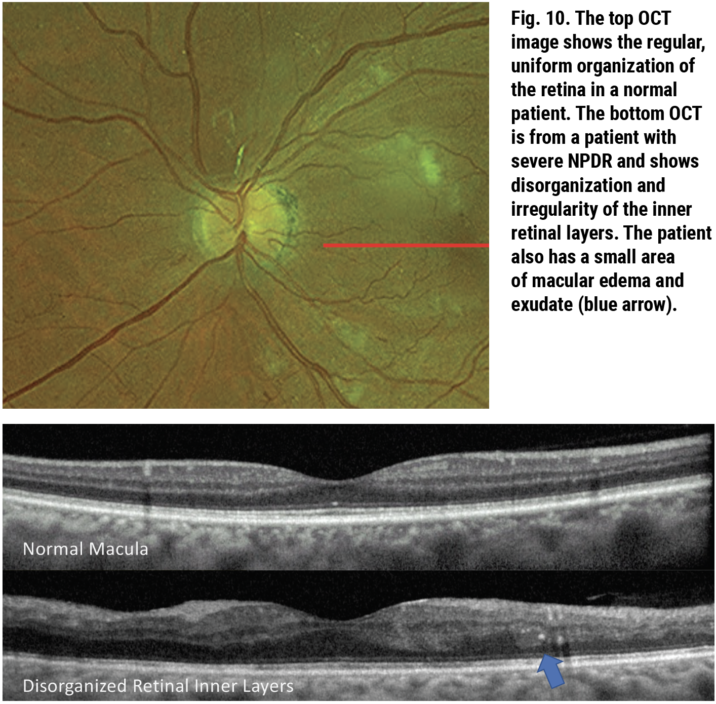 Fig. 10. The top OCT image shows the regular, uniform organization of the retina in a normal patient. The bottom OCT is from a patient with severe NPDR and shows disorganization and irregularity of the inner retinal layers. The patient also has a small area of macular edema and exudate (blue arrow).