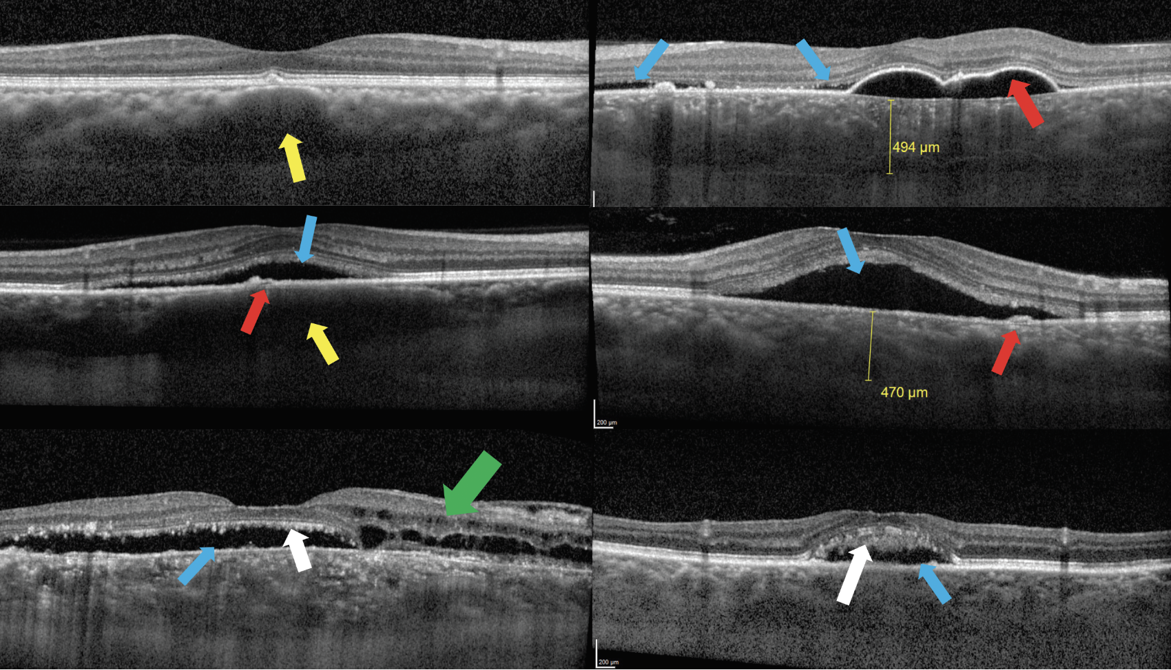 Fig. 11. Top left: Patient with pachydrusen overlying a pachyvessel (yellow arrow) with compression of Sattler’s layer and choriocapillaris. Top right: Patient with chronic case of CSR presents with pachychoroid, large serous PED (red arrow) and subretinal fluid (blue arrows). Middle left: Acute case of CSR presents with small PED (red arrow) and subretinal fluid (blue arrow) with underlying pachyvessel (yellow arrow) with compression of Sattler’s layer and choriocapillaris. Middle right: Acute case of CSR with pachychoroid, small PED (red arrow) and subretinal fluid (blue arrow). Bottom left and right: Chronic CSR presents with subretinal fluid (blue arrows) as well as intraretinal fluid (green arrow) and photoreceptor outer segment elongation or “shaggy photoreceptors” (white arrows).