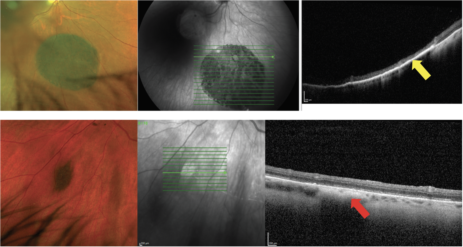Fig. 12. OCT can be used to differentiate between pigmented lesions of the posterior segment, such as congenital hypertrophy of the RPE (CHRPE), which are lesions of the RPE (top images), and choroidal nevi (bottom images). This pigmented CHRPE shows hyperreflectivity and thickening of the RPE with posterior shadowing but no involvement of the choroid (yellow arrow). The small nevus shows hyperreflectivity and posterior shadowing within the choroid (red arrow). 