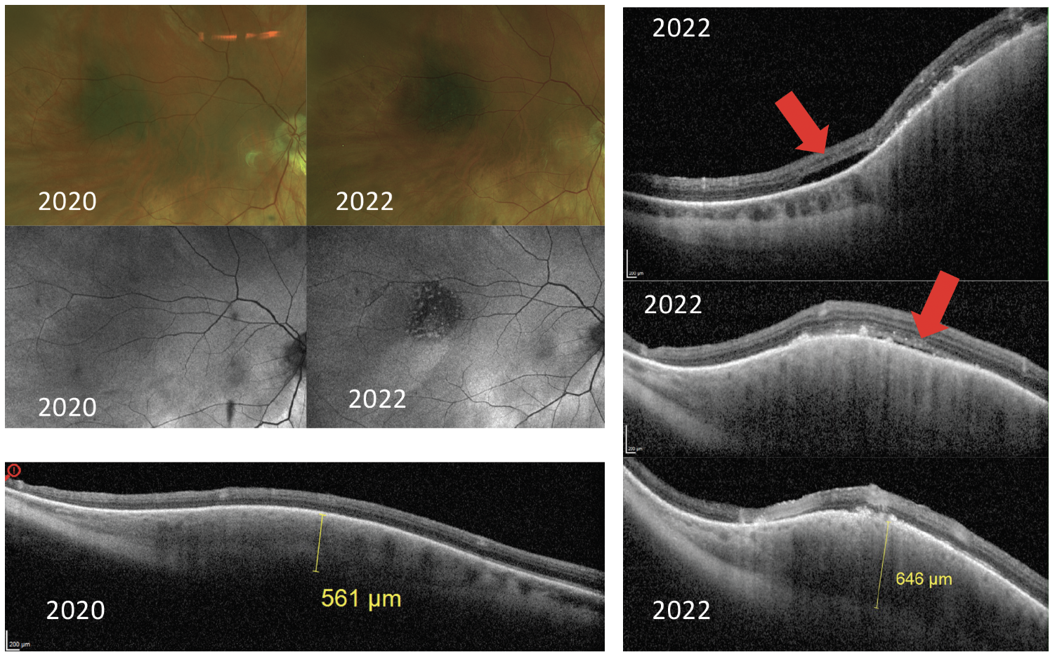 Fig. 13. A patient presents with a choroidal nevus in 2020 with normal overlying autofluorescence, total thickness on OCT of 561μm and no sign of subretinal fluid on OCT. In 2022, the lesion has mild growth in diameter, but there are concerning findings of hyper-autofluorescence on FAF, growth in thickness shown on OCT and new presence of subretinal fluid on OCT (red arrows). These findings are concerning due to the risk of conversion to ocular melanoma.