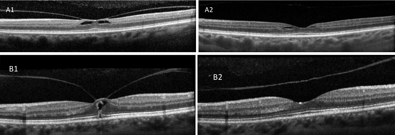 Fig. 15. Local VMT with foveoschisis (A1) spontaneously releases with improved macular contour (A2). Focal VMT with macular hole (B1) spontaneously released with normalized macular contour (B2). 