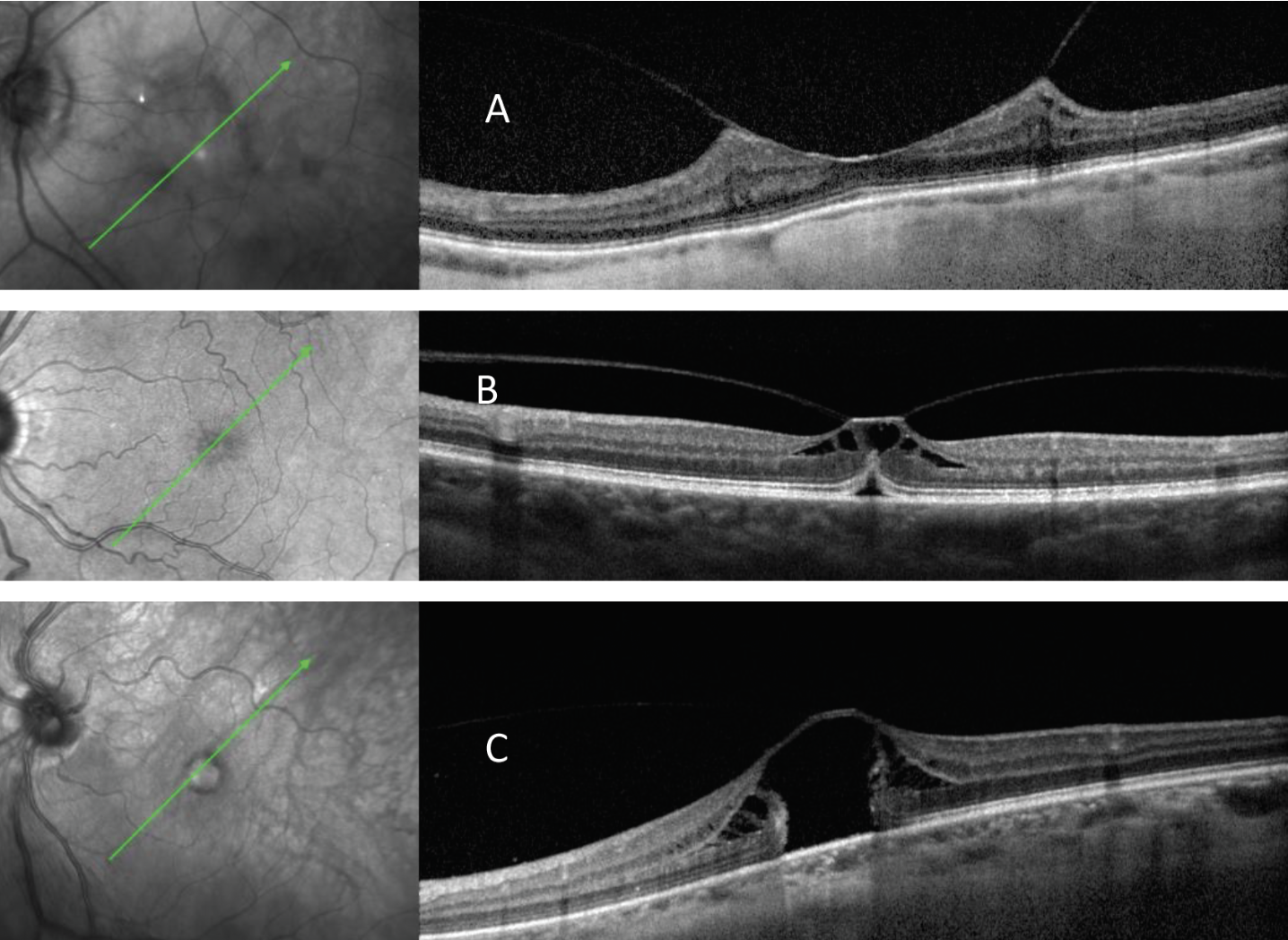 Fig. 16. Broad VMT with epiretinal membrane (A) vs. focal VMT (B and C) with two different macular hole configurations. 