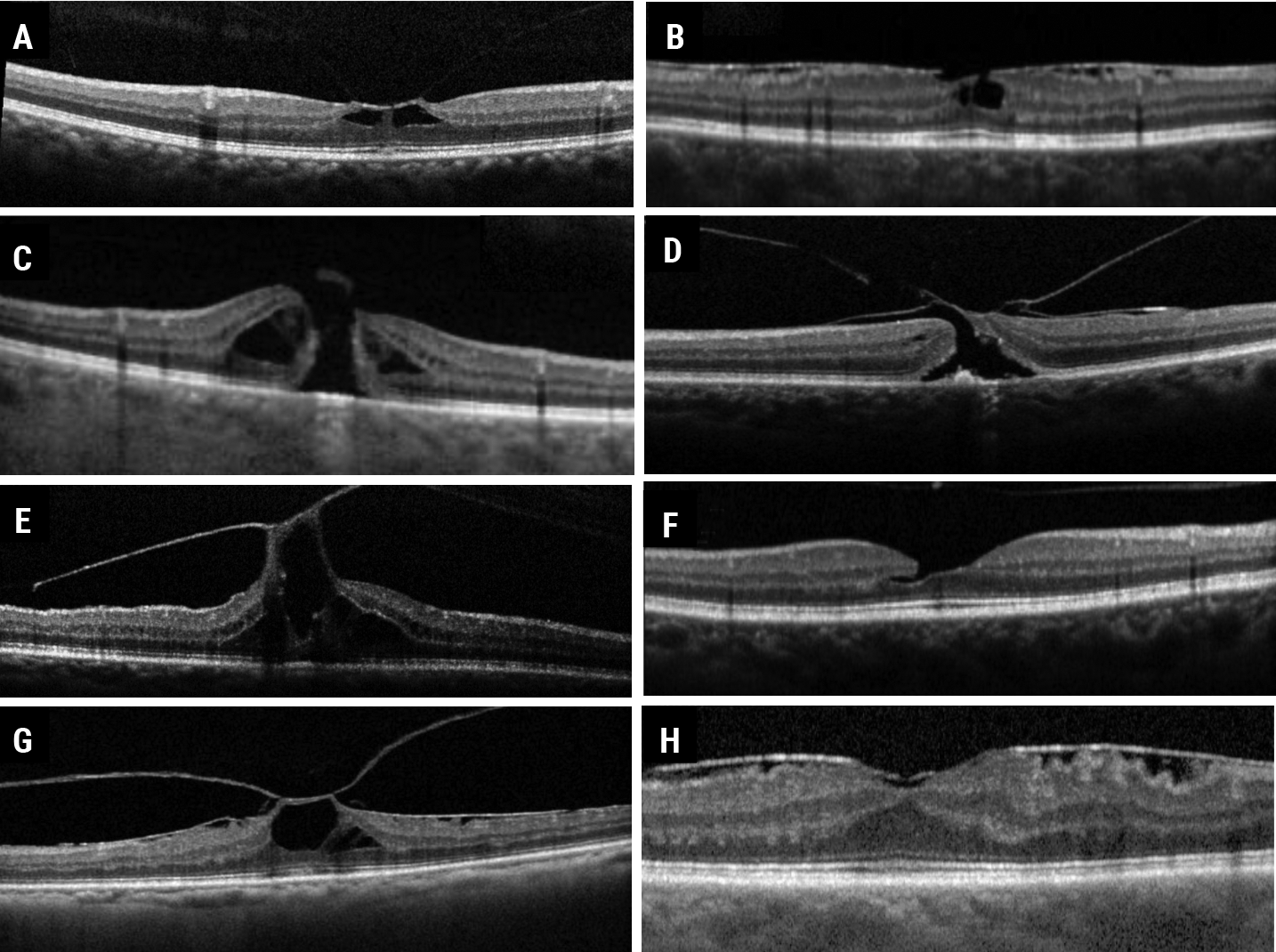 Fig. 17. VMT (A) taxonomy leading to one of the following potential clinical courses: epiretinal or epimacular membrane and lamellar macular hole (B), full-thickness macular hole (C), full-thickness macular hole with epimacular membrane (D), persistent VMT combined with macular hole (E), or released with lamellar macular hole (F), or persistent with epimacular membrane and macular hole (G) or epimacular membrane (H).