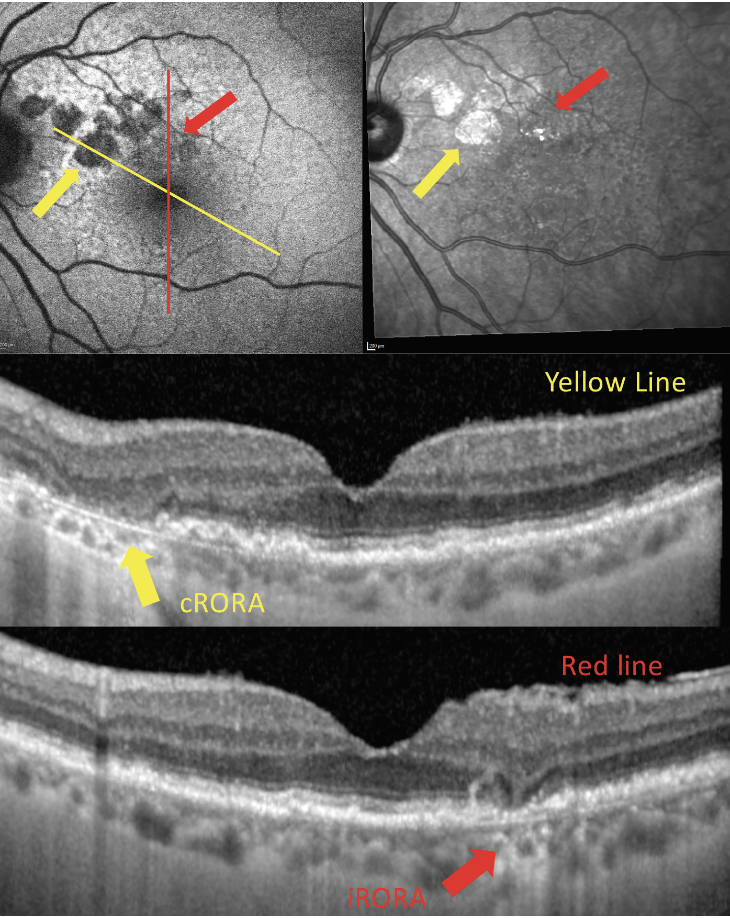 Fig. 4. OCT, FAF (top left) and infrared reflectance (top right) imaging of a patient with regions of both cRORA and iRORA.