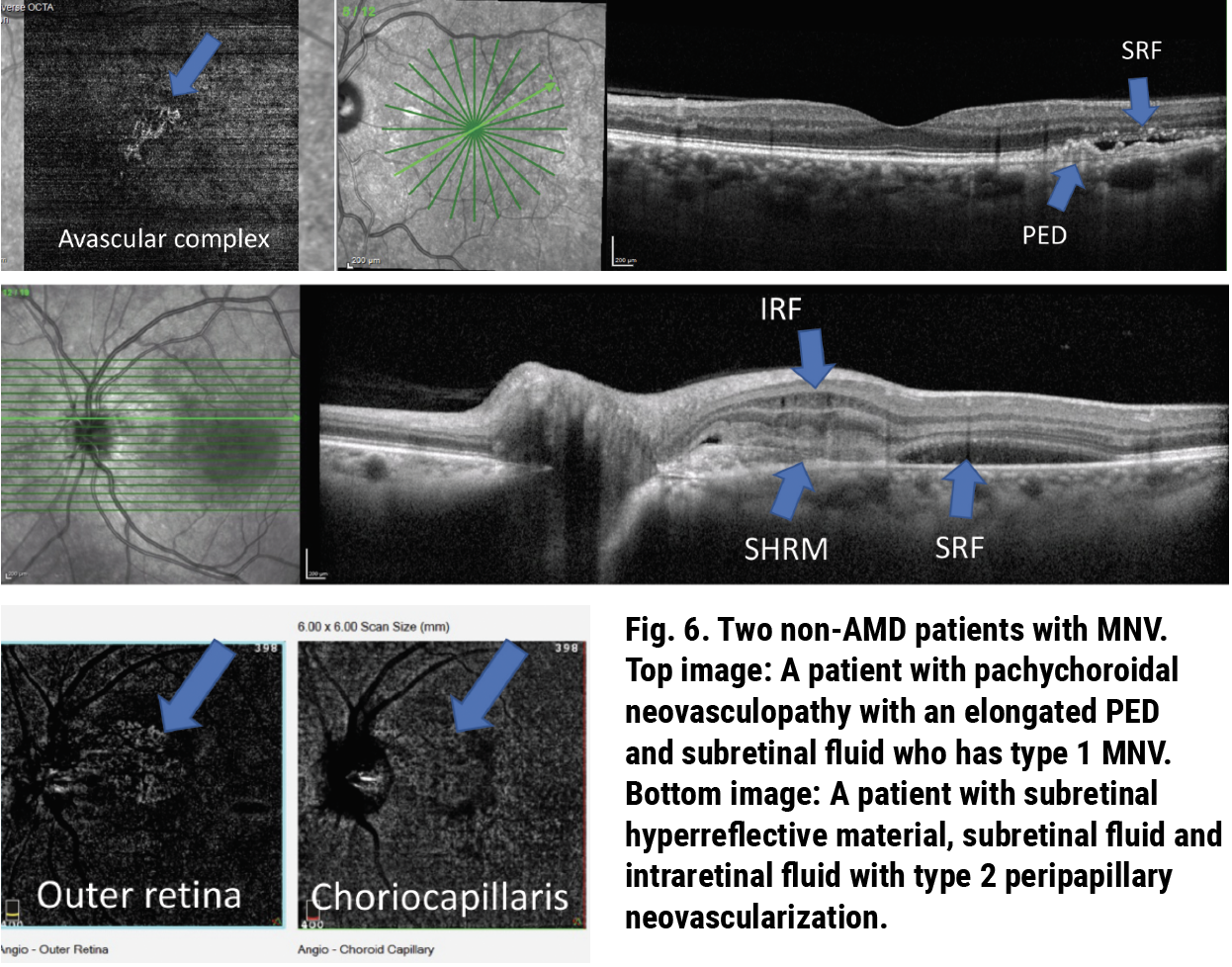 Fig. 6. Two non-AMD patients with MNV. Top image: A patient with pachychoroidal neovasculopathy with an elongated PED and subretinal fluid who has type 1 MNV. Bottom image: A patient with subretinal hyperreflective material, subretinal fluid and intraretinal fluid with type 2 peripapillary neovascularization.