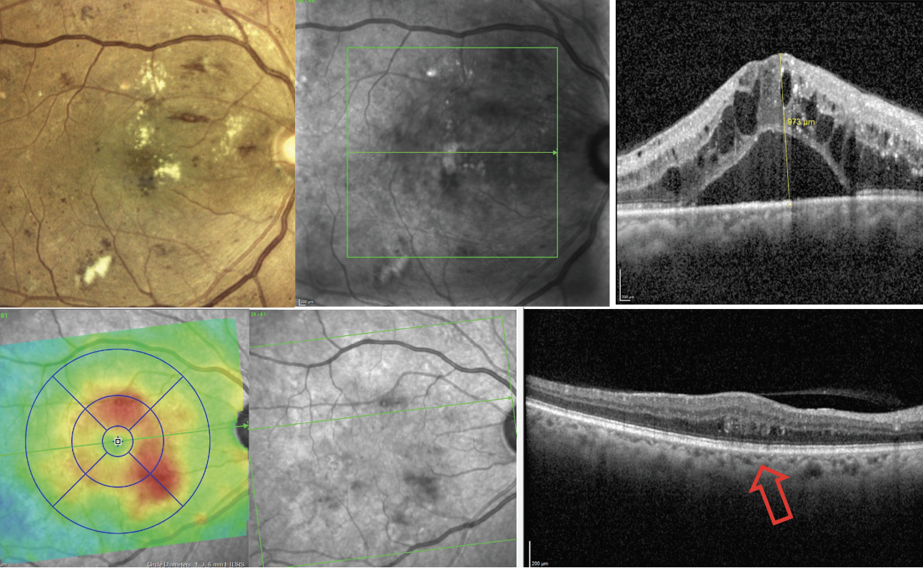 Fig. 8. OCT can be used to detect DME that is either clinically visible (top images) or not  (bottom images). The bottom left image is a retinal thickness map that helps display the distribution of macular thickening from edema.