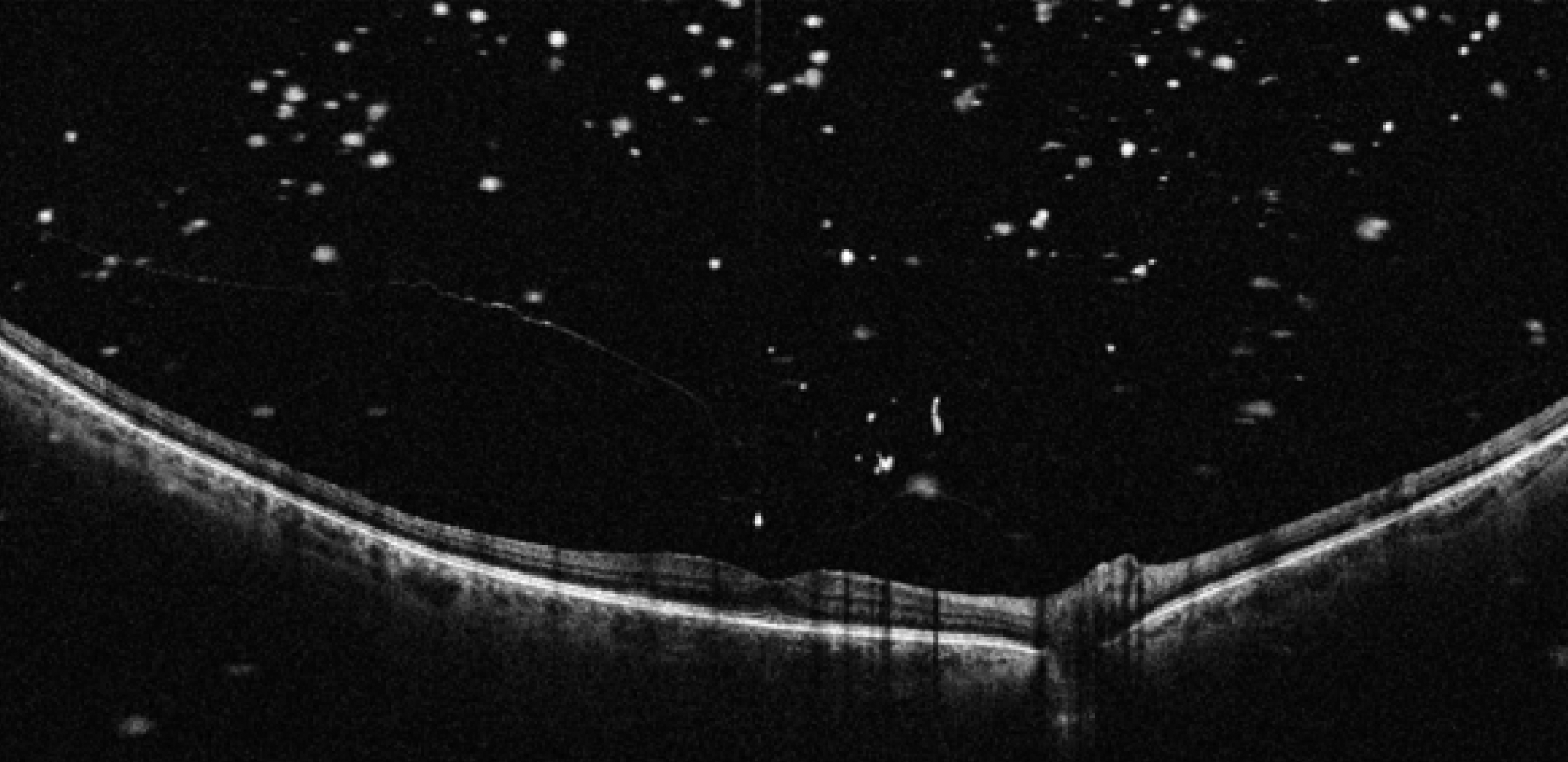 Posterior vitreous opacity and vitreomacular traction in a patient with with subfoveal outer lamellar macular hole and initial foveal schisis.