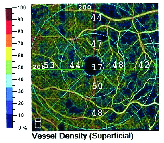 Macular microcirculation declined significantly in early POAG and NTG patients.