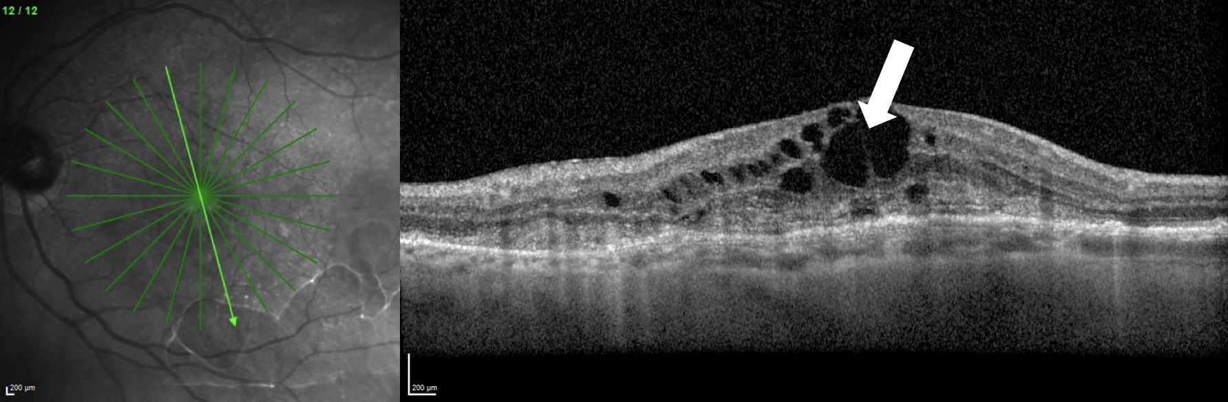 Intraretinal fluid (white arrow), shown here in a patient with macular neovascularization, was one of the areas of widest disagreement among the experts who assessed OCT scans in the trial.