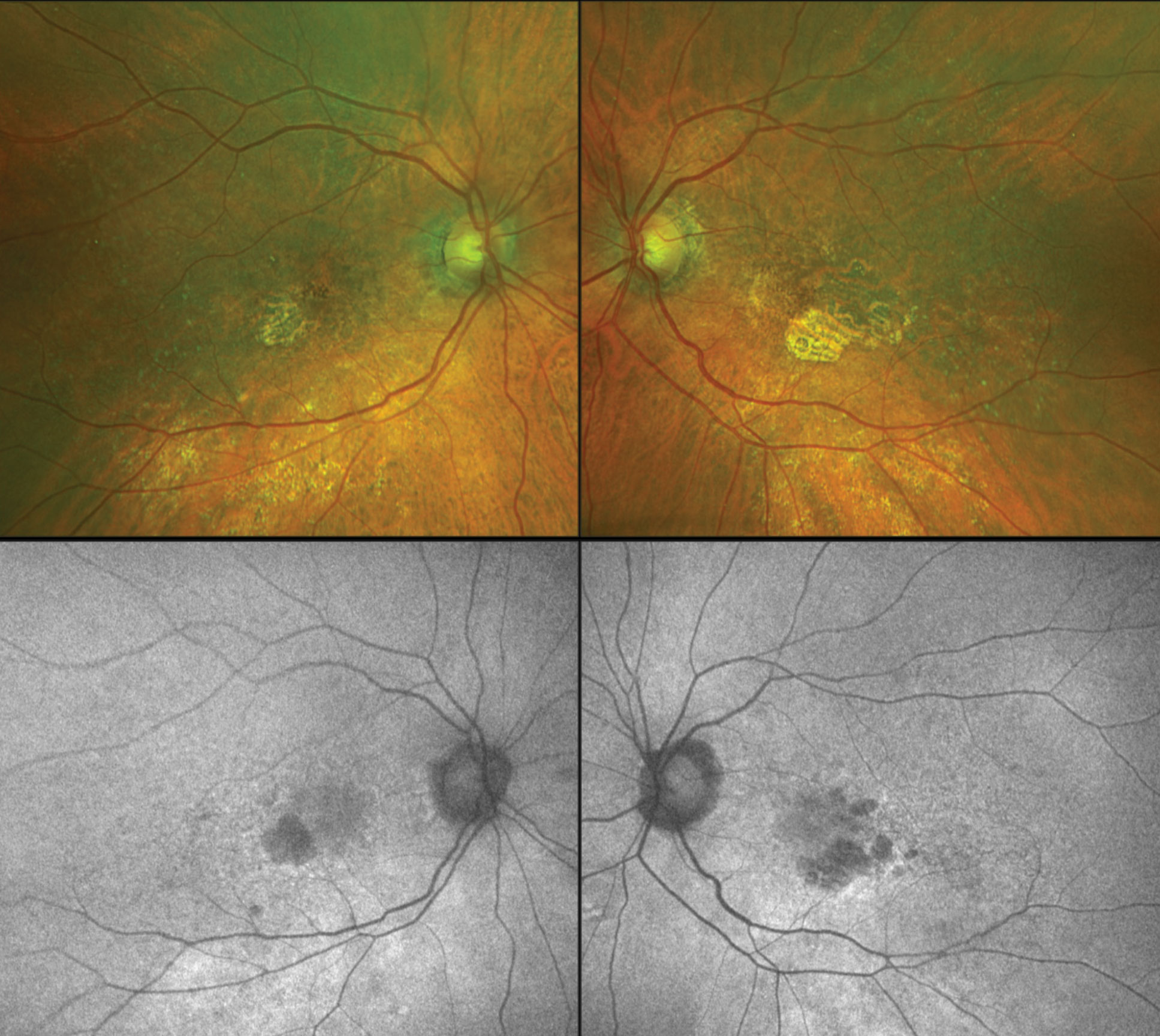 : A new form of autofluorescence imaging was able to differentiate two potential disease pathways in geographic atrophy, originating from intermediate AMD lesions, to help simplify and aid research.