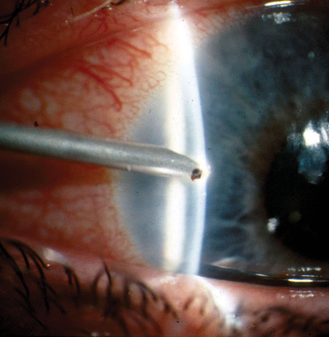 The incidence rate of infectious keratitis within three days post-corneal foreign body removal was around 5% in this study and non-dependent on treatment (antiseptics vs. antibiotics).