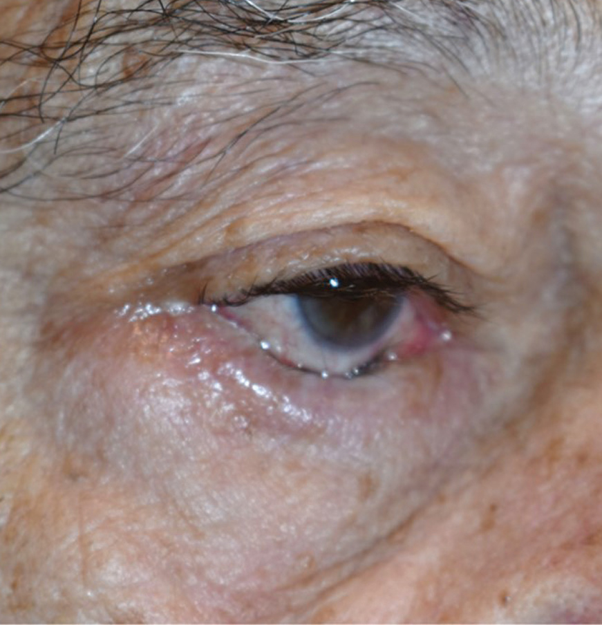 A recent study examined changes in the position of the lower lacrimal punctum and tear meniscus height after addressing horizontal laxity of the lower eyelid in patients with involutional entropion.