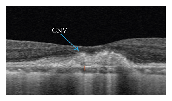 High myopes may be at increased risk for choroidal neovascularization if they’re older or have decreased choroidal vascular density. 