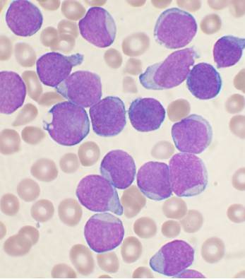 Patients in this small study with acute leukemia had significantly more hyperreflective foci than controls, though this number was reduced after remission.