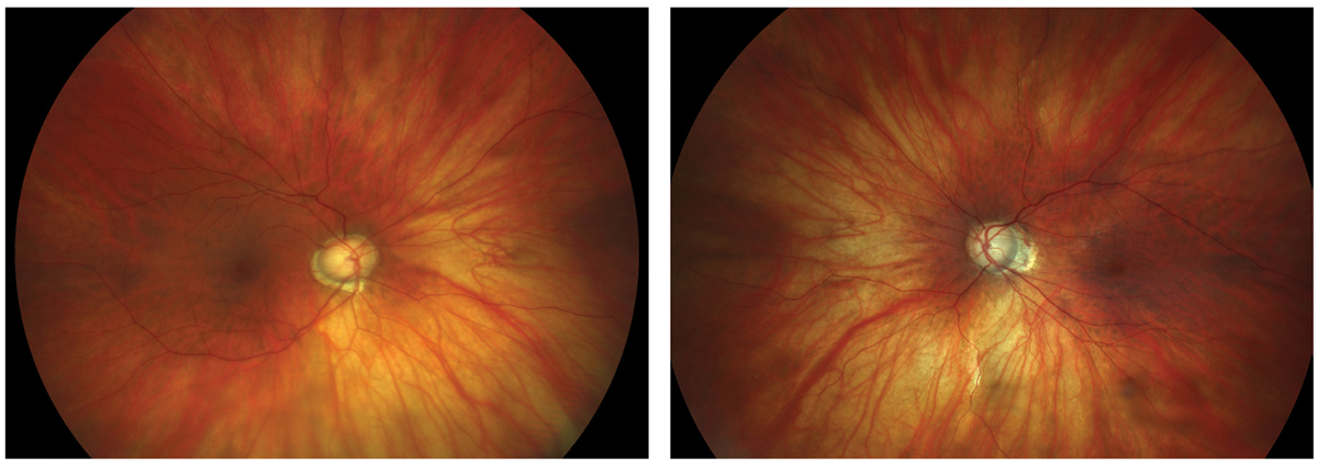 Variations in myopia definitions yield different prevalences of the condition, making cross-study comparison difficult, but findings from this study may offer a new means of comparison.