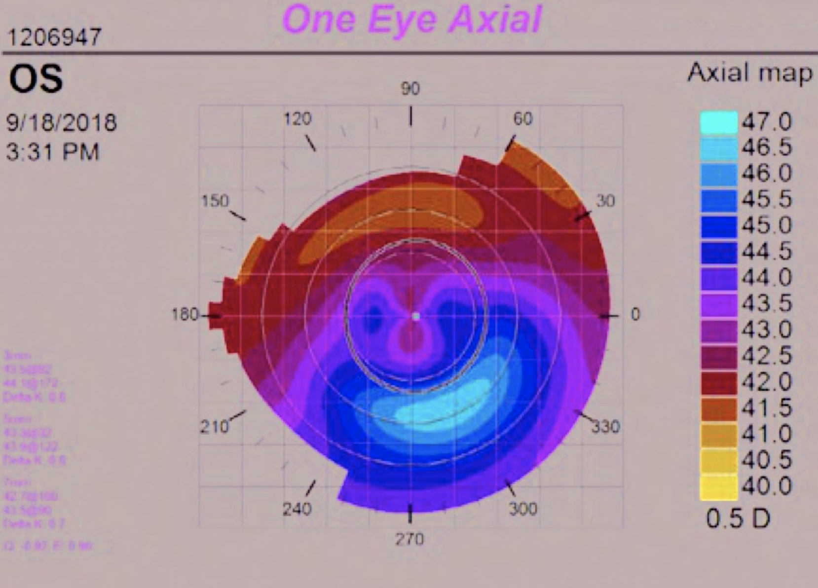Preterm children had greater corneal ectasia, and laser treatment for ROP caused further corneal steepness and higher anterior corneal astigmatism.