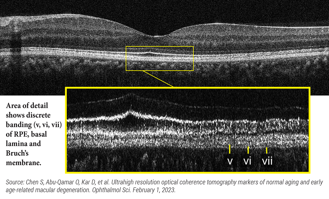 Ultrahigh resolution SD-OCT can enable in vivo and longitudinal assessment of key AMD pathological features, which are typically accessible only ex vivo. In this scan, from a healthy 29-year-old Asian female, the RPE/basal lamina/Bruch’s split is evident. Hyperreflective bands #v and #vii, as well as the hyporeflective band #vi, are resolved across almost the entire field.