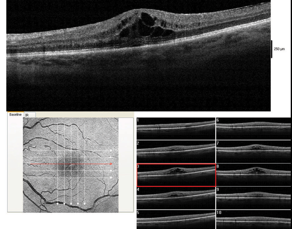 : Those who have pseudophakic cystoid macular edema in one eye have a 10.7% risk of developing the condition in the fellow eye, compared with a 0.9% risk without first-eye involvement.