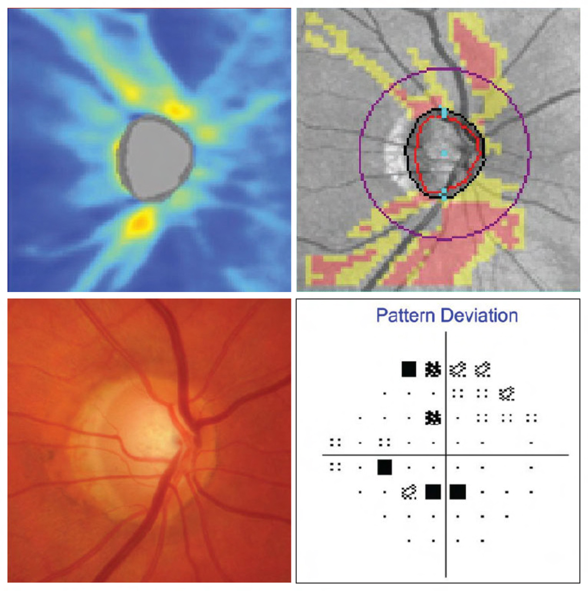 The combination of OCT and VF greatly improved detection of glaucoma worsening.