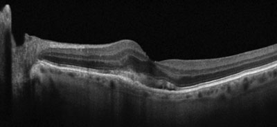 Choroidal thinning is more pronounced in advanced chronic kidney disease.