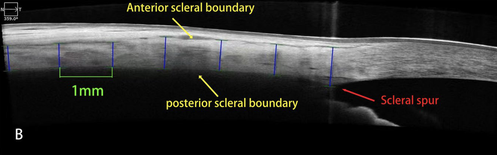 Anterior scleral thickness is negatively correlated with axial length and positively correlated with age.