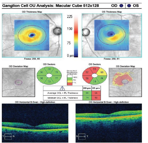 This study shows a good agreement between RNFL bundle defects and perimetric loss in patients with glaucoma.