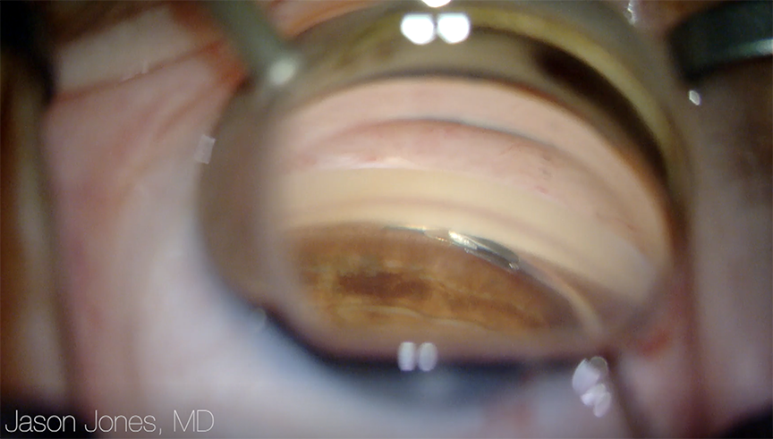 Combining a microstent MIGS device with cataract surgery reduced the rate of VF worsening compared with cataract surgery alone in POAG patients, even when both groups had equal access to medical IOP-lowering.