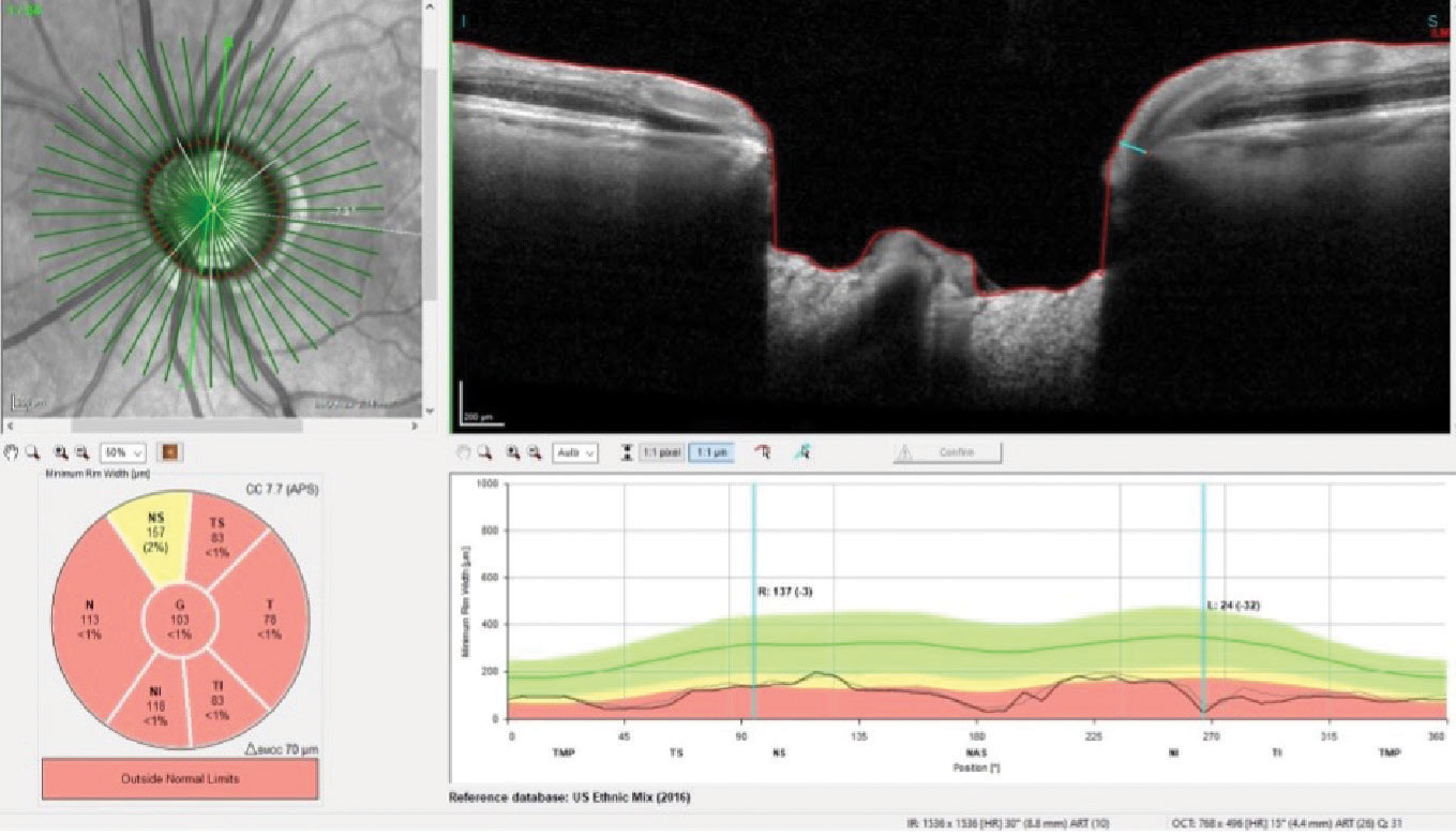 Thinned BMO neuroretinal rim tissue OS, with some thinning of the superior rim down to a paltry 24µm of tissue.