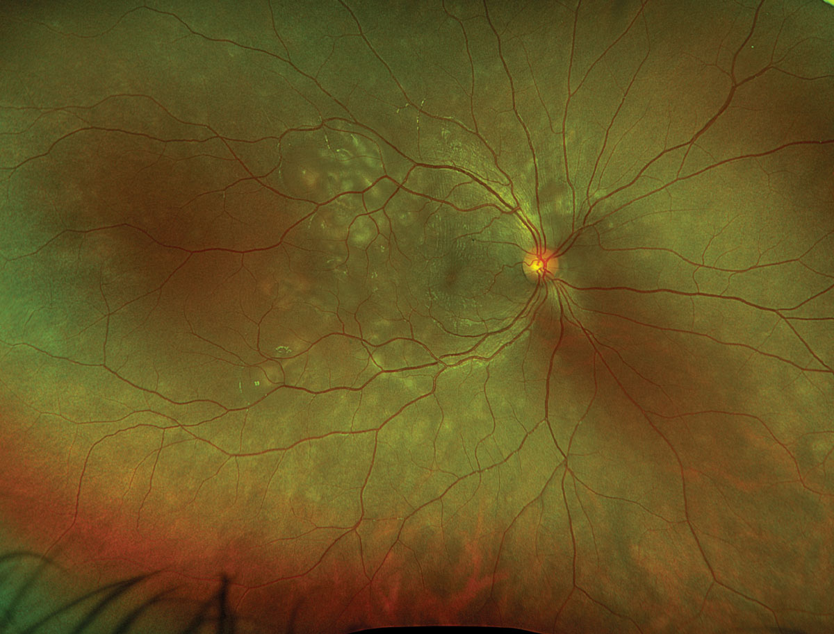 Fig. 1. Optos widefield fundus photography of the right eye at presentation.