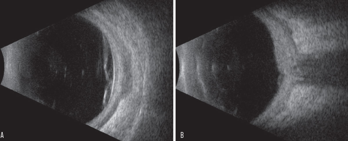 Fig. 3. (A) Transverse B-scan of the globe at the 9 o’clock hour at the equator. (B) Vertical axial B-scan over the posterior pole.