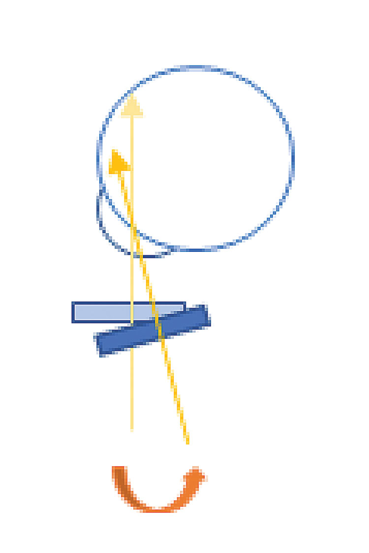 Fig. 6. A schematic of tilting the lens at the slit lamp. Tilting the condensing lens can direct the light more peripherally. 
