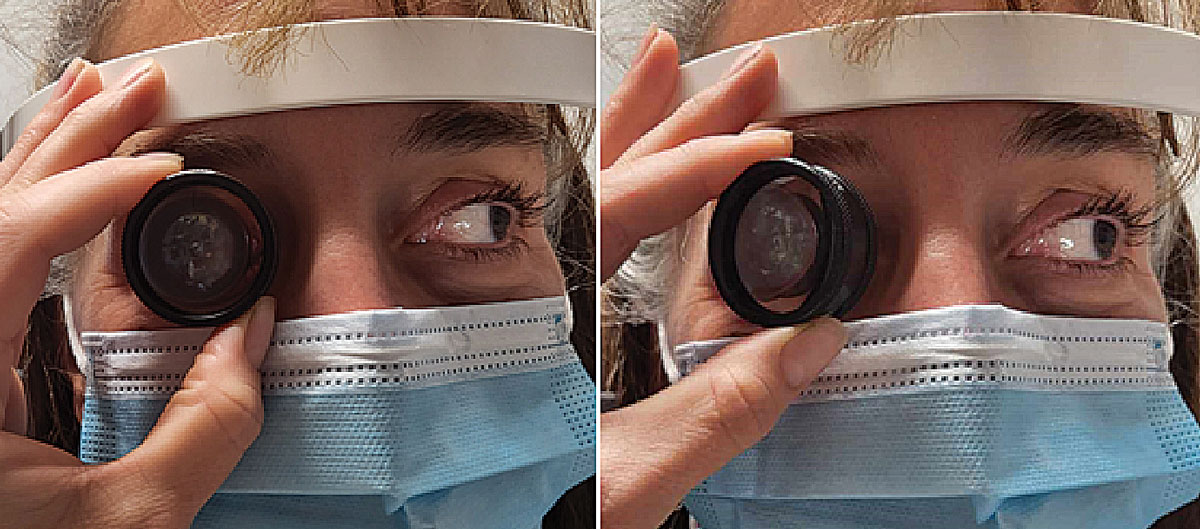 Fig. 7. Here is an example of tilting the condensing lens for peripheral view. Tilt toward the side of the face of the condensing lens that is opposite to the area you want to examine. For example, if the patient is looking left, tilt the left (your left) part of the lens laterally toward the face.